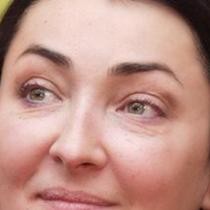 лолита,ботокс,пластическая операция